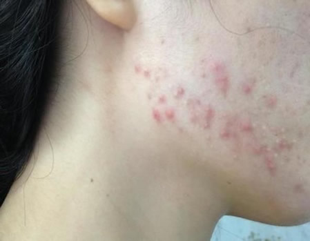 下巴长痘痘是什么原因：下巴长痘痘怎么办（图）