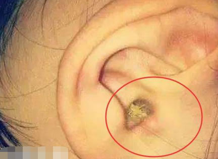 身体好不好看耳屎颜色就是知道（图）