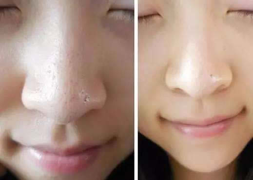 三种DIY方法教你轻松去除顽固黑头:让你精致秀气 三种DIY方法教你轻松去除顽固黑头:让你精致秀气