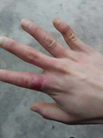 冬天手冻了怎么办:冬季预防手被冻伤方法及偏方 冬天手冻了怎么办:冬季预防手被冻伤方法及偏方