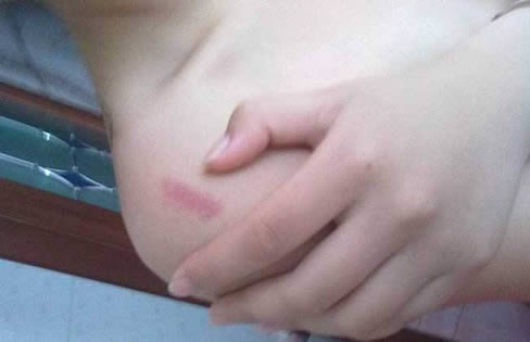 种草莓的吻痕:种草莓吻痕的技巧及消除方法 种草莓的吻痕:种草莓吻痕的技巧及消除方法