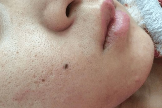 毛孔里挤出这东西竟是肝脏毒素太多（图）