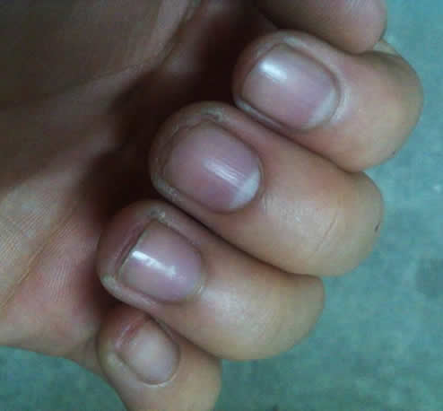 手指甲发紫：指甲颜色透露健康状况