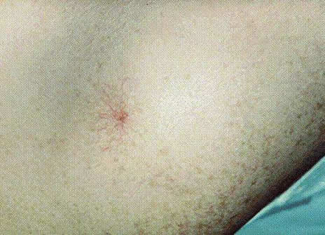 蜘蛛痣图片:为什么会有蜘蛛痣介绍 蜘蛛痣图片:为什么会有蜘蛛痣介绍