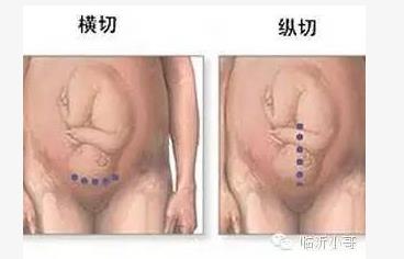 产前必知!剖腹产横切竖切差别竟然这么大! 产前必知!剖腹产横切竖切差别竟然这么大!