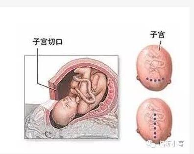 产前必知!剖腹产横切竖切差别竟然这么大! 产前必知!剖腹产横切竖切差别竟然这么大!