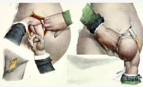 产前必知!剖腹产横切竖切差别竟然这么大! 产前必知!剖腹产横切竖切差别竟然这么大!