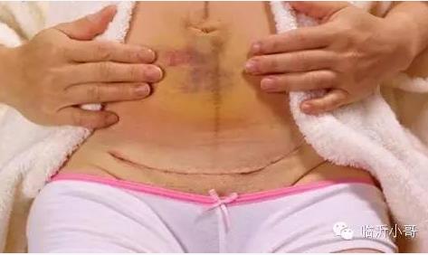 产前必知!剖腹产横切竖切差别竟然这么大! 产前必知!剖腹产横切竖切差别竟然这么大!