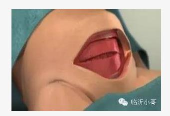 产前必知!剖腹产横切竖切差别竟然这么大! 产前必知!剖腹产横切竖切差别竟然这么大!