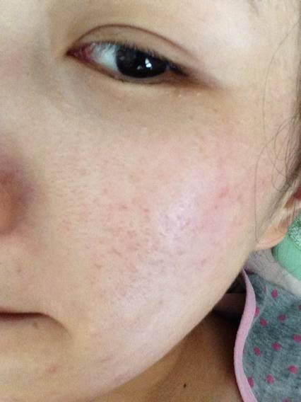 毛孔粗大怎么办?6个方法帮你解决粗黑毛孔(快来学) 毛孔粗大怎么办?6个方法帮你解决粗黑毛孔(快来学)