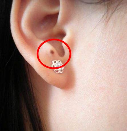 耳朵上有痣图解耳朵上长痣代表什么好不好