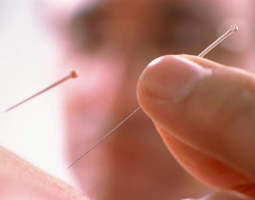 15年的老痔疮竟用一根针搞定了:针灸技术(图) 15年的老痔疮竟用一根针搞定了:针灸技术(图)