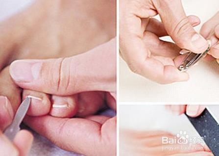 脚趾甲往肉里长?原来是剪错了形状导致的（图）