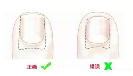 脚趾甲往肉里长?原来是剪错了形状导致的（图）