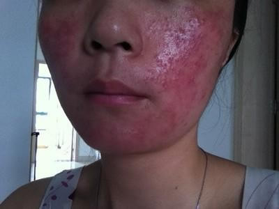 激素脸的症状:什么是激素脸?怎么治疗维护 激素脸的症状:什么是激素脸?怎么治疗维护