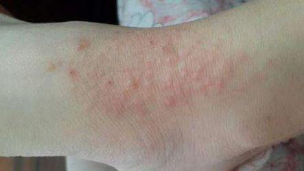 脚上小疙瘩特别痒:怎么回事(图) 脚上小疙瘩特别痒:怎么回事(图)