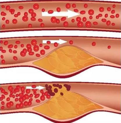 血管堵塞的罪魁祸首