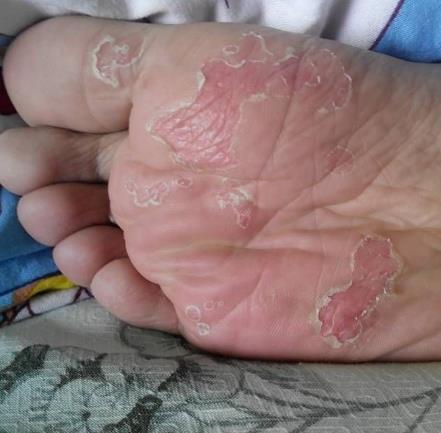 脚底的死皮直接用手撕?撕完还会有的