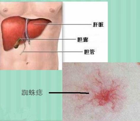 什么是蜘蛛痣图片：蜘蛛痣图片什么症状