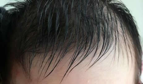 油性头发用什么洗发水 油性头发几天洗一次最好 油性头发怎么改善