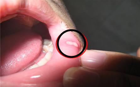 经常出现口腔溃疡? 吃这些食物要比你吃药还管用（图）