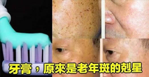没想到!牙膏竟是老年斑的克星（图）