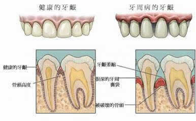 牙结石的危害清除了沉积29年的牙结石太爽了图