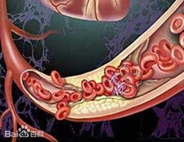 大蒜配它一起吃,疏通血管,一生不得血栓,癌症也躲着你走!