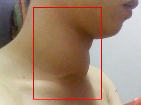 脖子上长这东西有可能是癌症信号:注意留意(图) 脖子上长这东西有可能是癌症信号:注意留意(图)