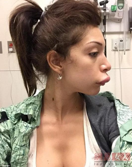 丰唇手术失败嘴唇增厚像鸭子（图）