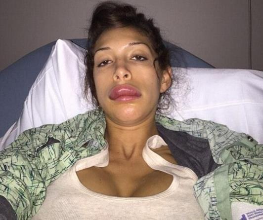 丰唇手术失败嘴唇增厚像鸭子（图）