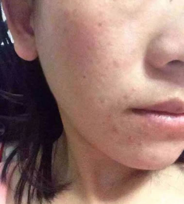 美白又去脸上的斑:告诉你一个民间淡斑方法 美白又去脸上的斑:告诉你一个民间淡斑方法