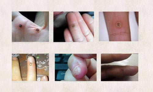 怎样去除脚掌上的鸡眼和老茧 怎样去除脚掌上的鸡眼和老茧