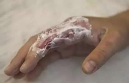 烫伤后怎么处理,用牙膏冰块等方式不靠谱 烫伤后怎么处理,用牙膏冰块等方式不靠谱