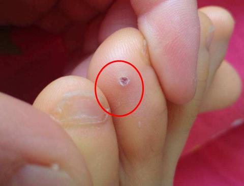 鸡眼怎么治 脚上长了鸡眼怎么治 鸡眼怎么治 脚上长了鸡眼怎么治