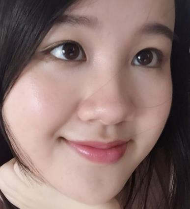 戴美瞳眼角膜成这样:长期戴美瞳的危害,戴美瞳注意事项 戴美瞳眼角膜成这样:长期戴美瞳的危害,戴美瞳注意事项