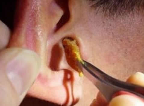 耳屎到底该不该挖?很多人都做错了(图) 耳屎到底该不该挖?很多人都做错了(图)