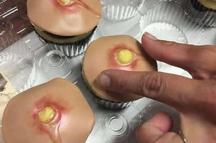 女孩挤痘痘得败血症：痘痘挤还是不挤,真相在这里