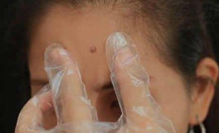 女孩挤痘痘得败血症：痘痘挤还是不挤,真相在这里