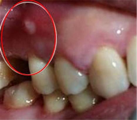 智齿一定要拔吗:智齿有何作用,拔智齿的最佳年龄 智齿一定要拔吗:智齿有何作用,拔智齿的最佳年龄