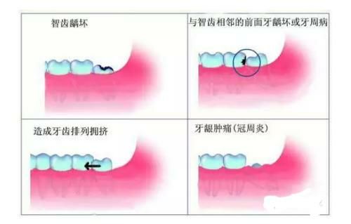 智齿一定要拔吗:智齿有何作用,拔智齿的最佳年龄 智齿一定要拔吗:智齿有何作用,拔智齿的最佳年龄
