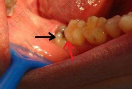 智齿一定要拔吗：智齿有何作用,拔智齿的最佳年龄