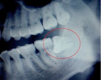 智齿应该拔掉吗：智齿拔掉后有个洞怎么办