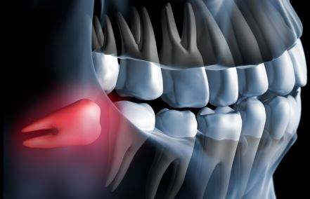 拔四颗智齿对脸型影响：什么是智齿,智齿拔了会有什么影响