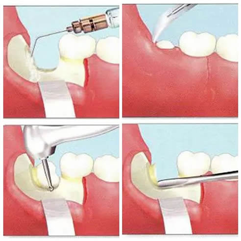 拔四颗智齿对脸型影响：什么是智齿,智齿拔了会有什么影响