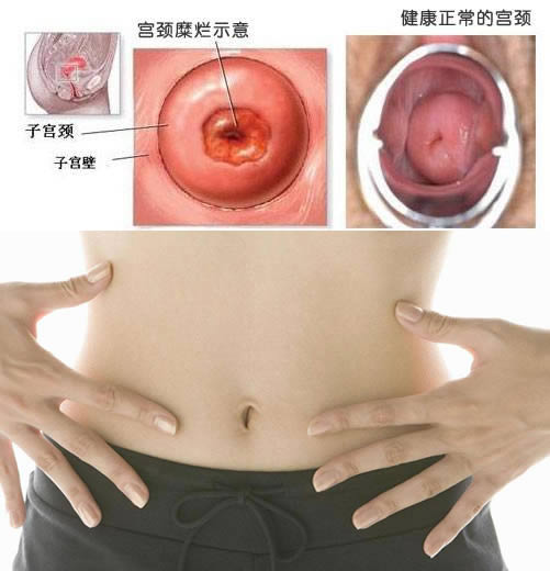 宫颈糜烂的原因：引起宫颈糜烂的原因,宫颈糜烂预防方法