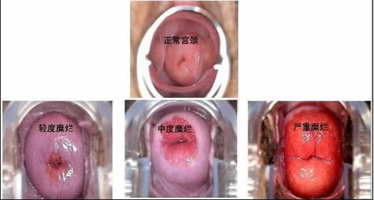 宫颈糜烂的症状：早期症状有哪些,宫颈糜烂用什么药好