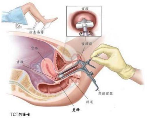 宫颈糜烂的症状：早期症状有哪些,宫颈糜烂用什么药好
