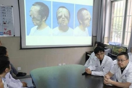 我自己都不敢照镜子……18岁的小伙成狮面人,小杨患有神经纤维瘤症