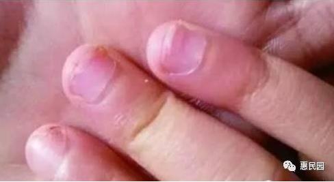 指甲上突然长出这东西要小心了（图）